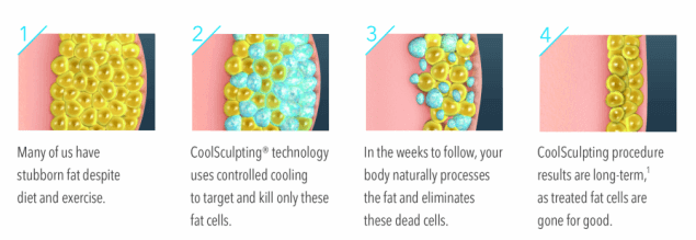 coolsculpting-fat-cells
