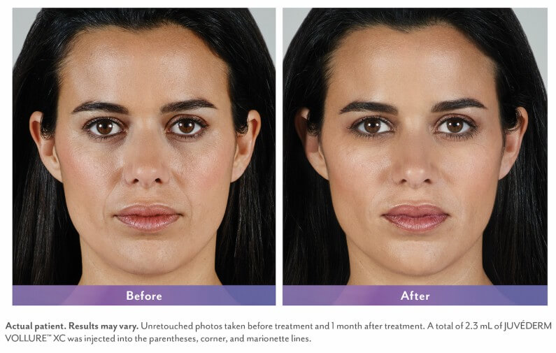 juvederm vollure bellevue