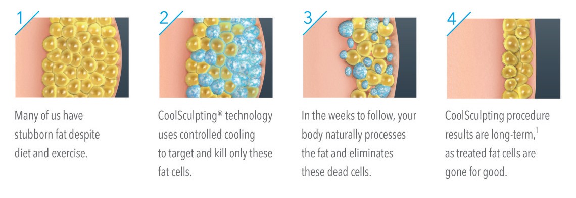 CoolSculpting in Redmond