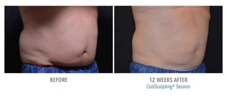 Before and After CoolSculpting