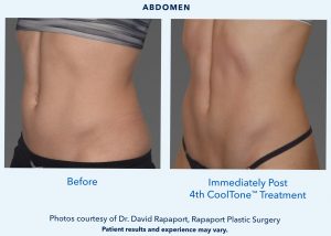 CoolTone and CoolSculpting provider in Bellevue