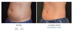 compliment a home work out routine with coolsculpting