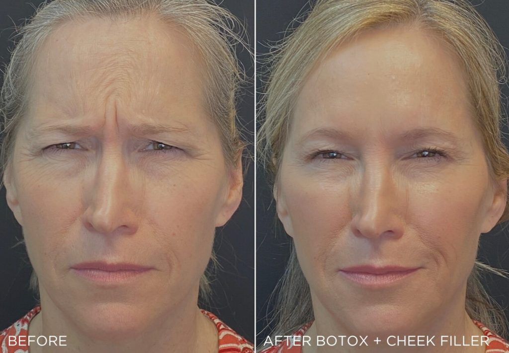 Botox vs fillers