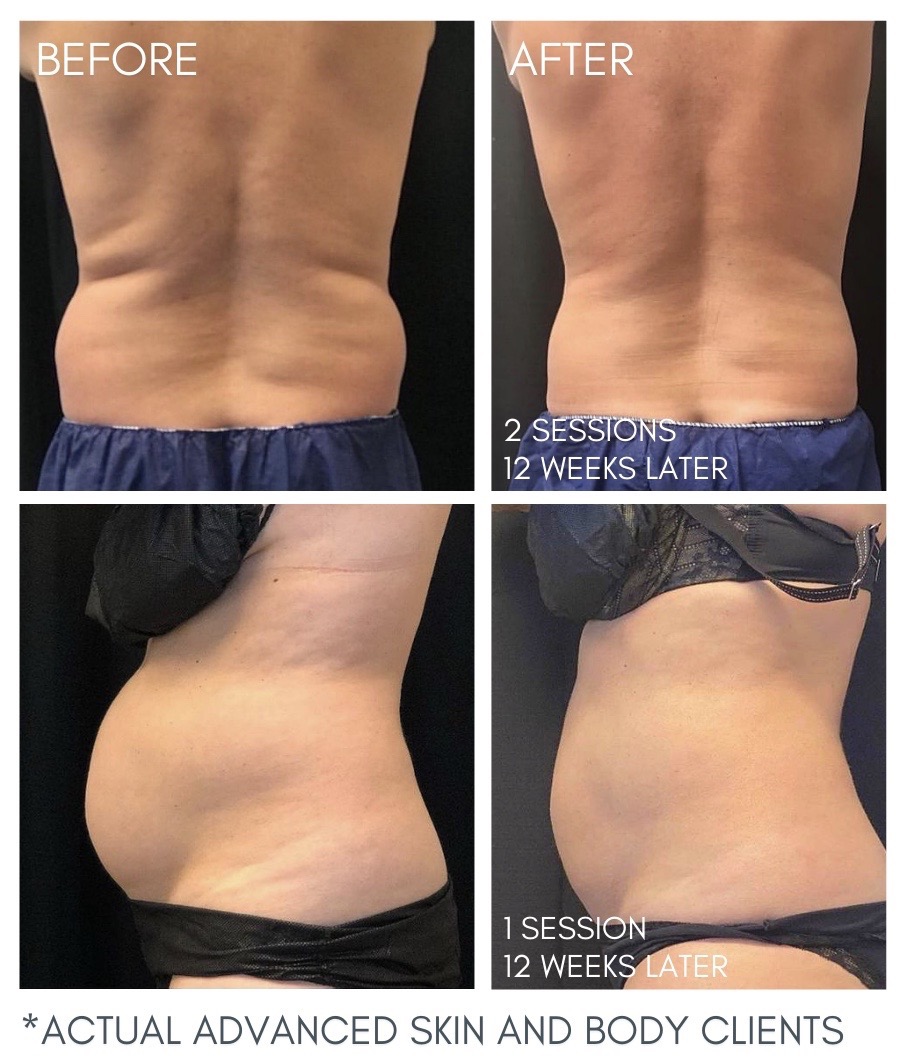 DualSculpting With CoolSculpting ELITE! ASBS MediSpa Bellevue