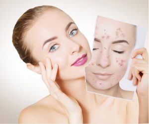 Acne in Bellevue