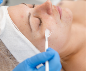 chemical peel