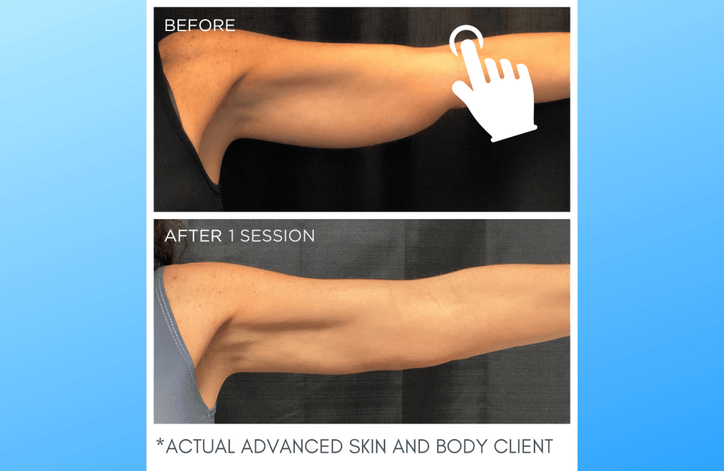 Before and After CoolSculpting | Advanced Skin & Body Solutions