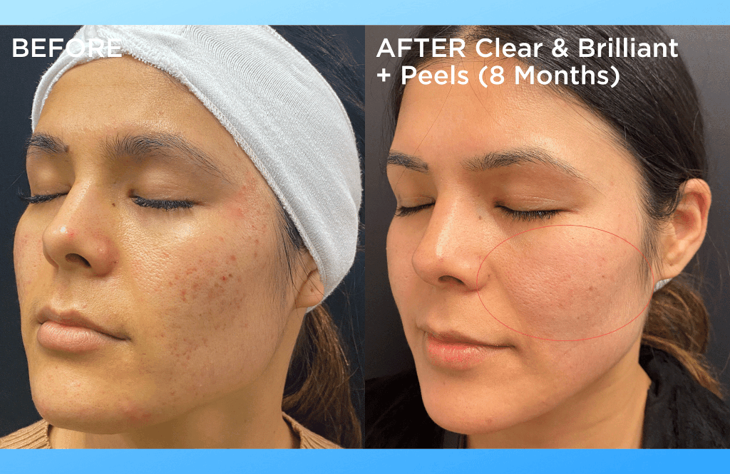 How Often Should You Get a Chemical Peel? - Rejuve Med-Spa