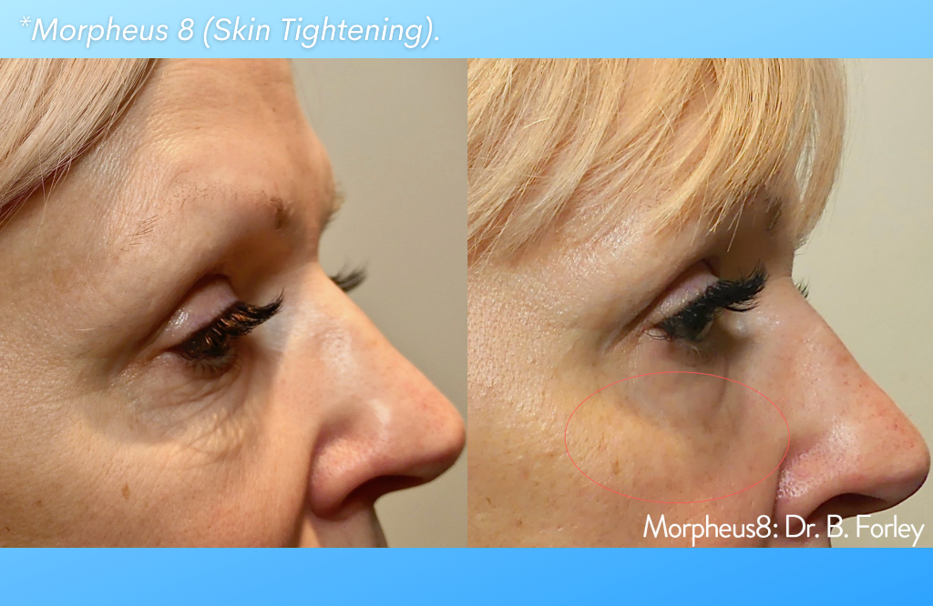 Morpheus8: Skin Tightening  Advanced Skin & Body Solutions