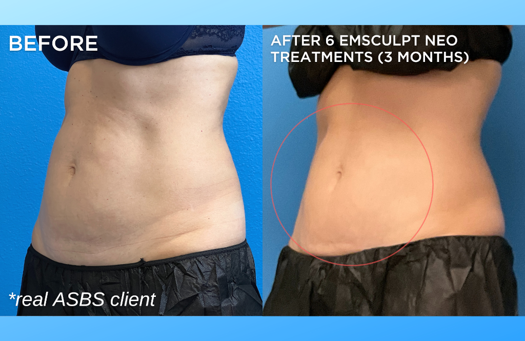 Emsculpt NEO, Body Conturing