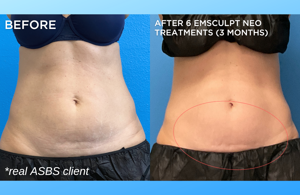 Emsculpt NEO, Body Conturing