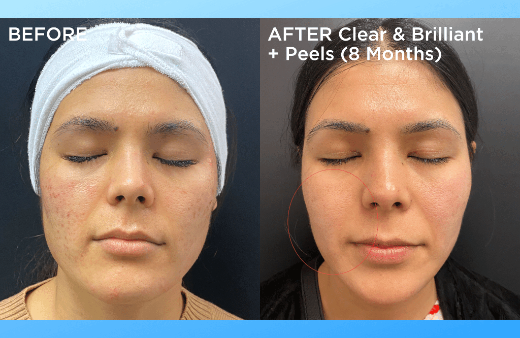 How Often Should You Get a Chemical Peel? - Rejuve Med-Spa