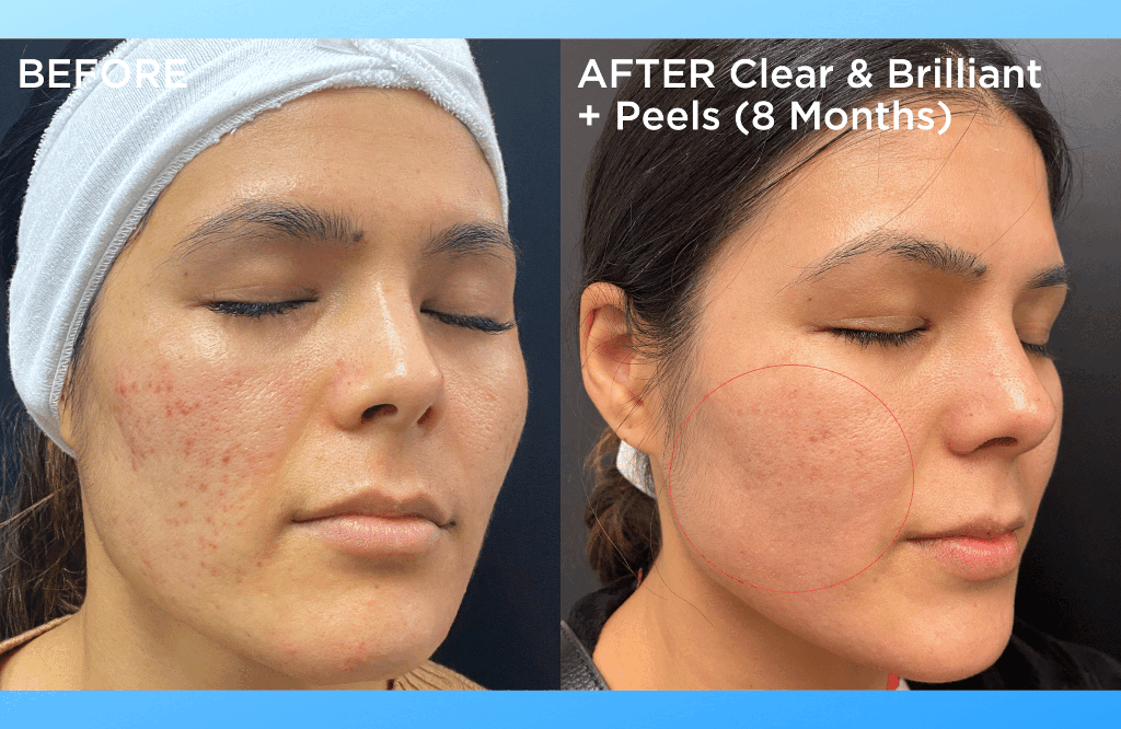 How Often Should You Get a Chemical Peel? - Rejuve Med-Spa